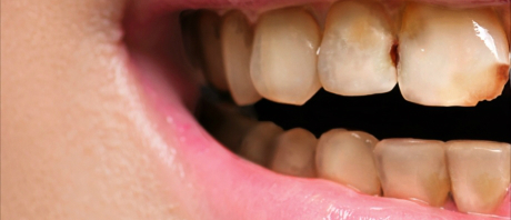 歯と歯ぐきの境目の黒ずみが気になる